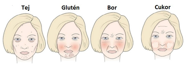laktózérzékenység tünetei arcon